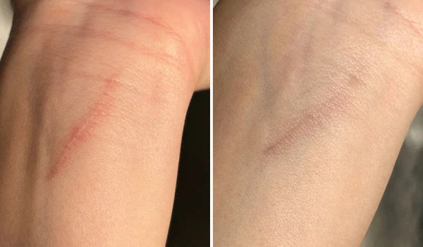 Luviva - Avanceret silikonebånd til behandling af ar og rynker