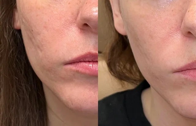 Luviva - Avanceret silikonebånd til behandling af ar og rynker