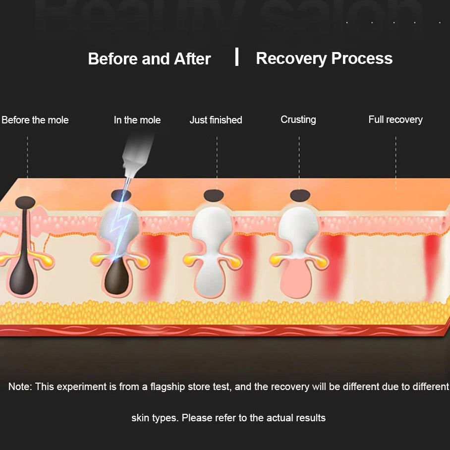 Plasmapenna Hudfliks Borttagare