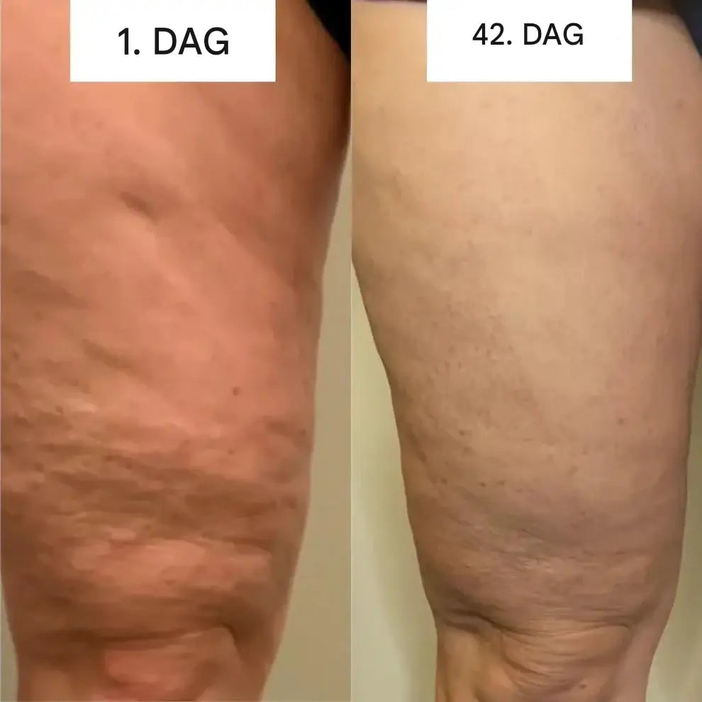 GlowCup - Cellulite Remover and Skin Tightening with Red Light and Cupping Therapy