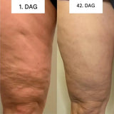 GlowCup - Cellulite Remover and Skin Tightening with Red Light and Cupping Therapy